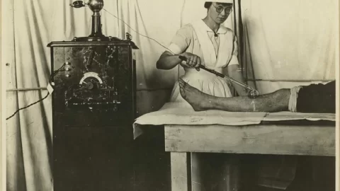 High frequency vacuum tube for peripheral stimulation. Use of electrical apparatus. [Physical therapy.] World War 1 era.