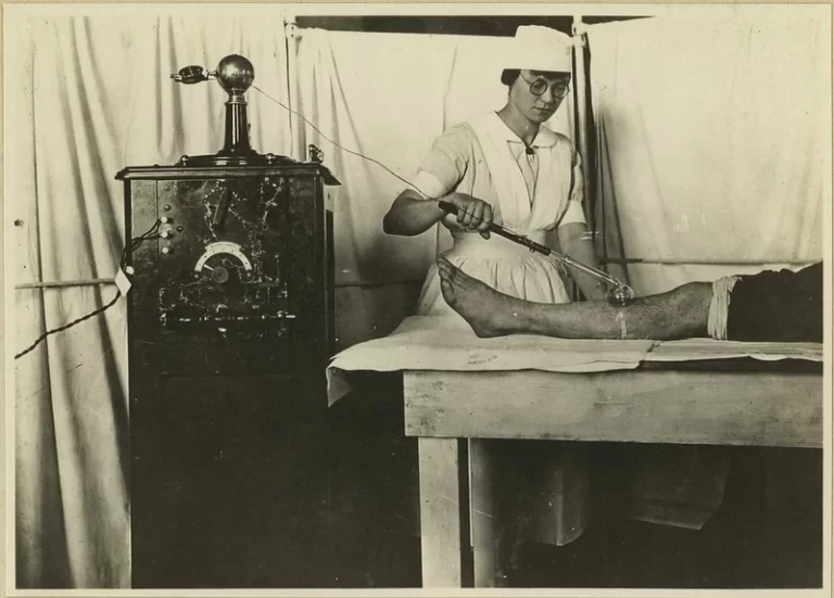 High frequency vacuum tube for peripheral stimulation. Use of electrical apparatus. [Physical therapy.] World War 1 era.