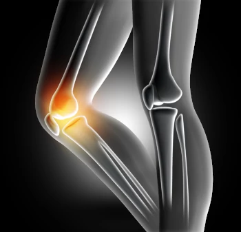 Knee Osteoarthritis - knee pain