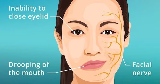 Illustration of a person with half of their face showing signs of weakness and drooping, representing Bell's Palsy.